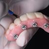 Implant Placement