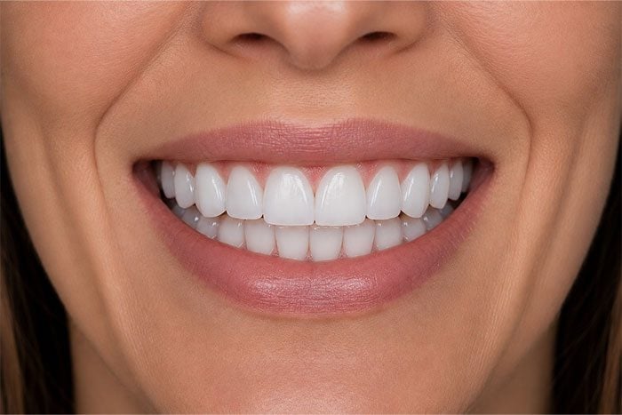 Porcelain-Veneers-Placement-Case-after